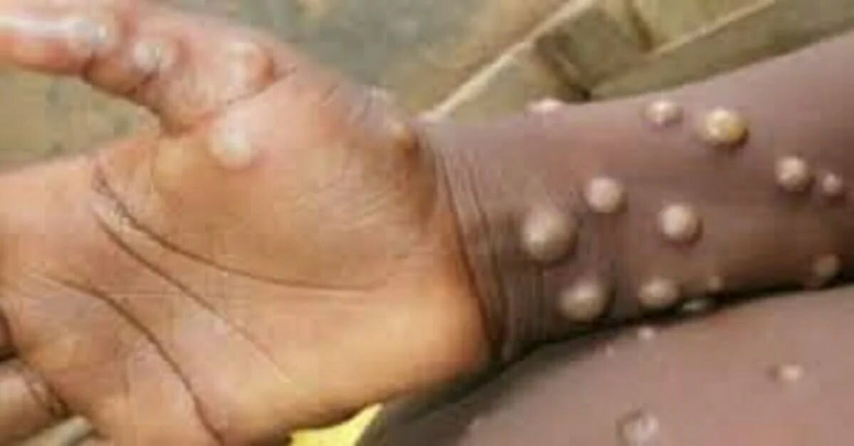 Monkeypox: इस देश में मंकीपॉक्स के 20 हजार से अधिक मामले, अब तक 50 राज्यों में फैला वायरस
